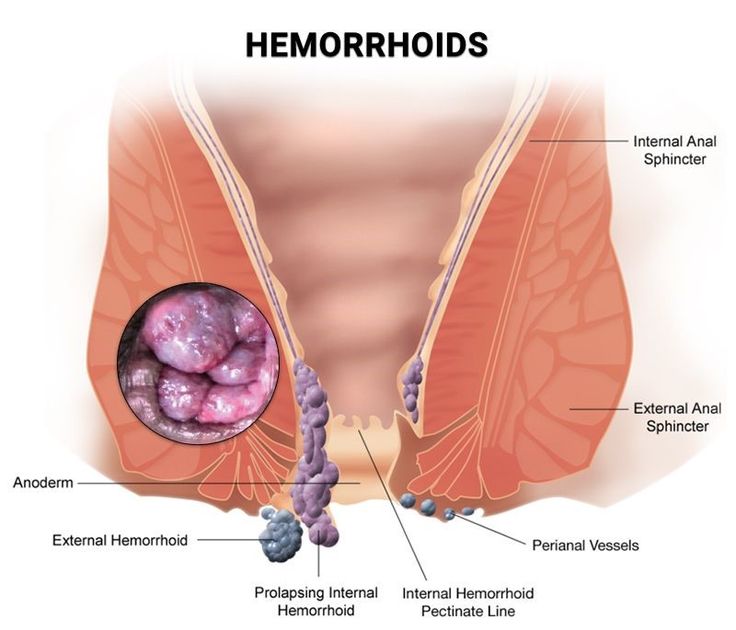 Hemoroid (Basur) İçin Hacamat ve Sülük